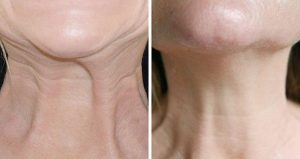 Neck Lift Botox - Before and After
