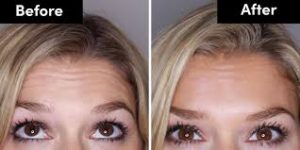 Forehead Lines Botox - Before and After